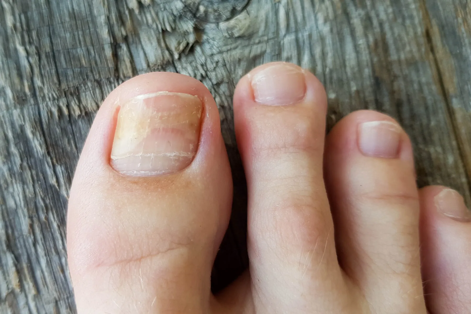 Glivice na nohtih? To je najboljša naravna rešitev, ki resnično deluje – in je dermatologi še vedno nočejo priznati!