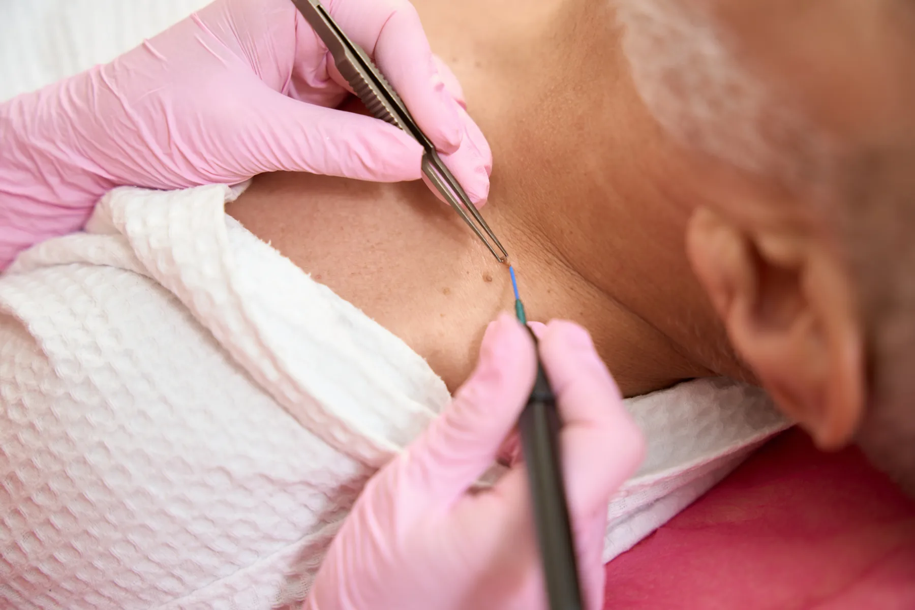 Kako odstraniti kožne izrastke doma (brez bolečin in brez obiska pri dermatologu) – te 3 domače rešitve delujejo presenetljivo dobro!