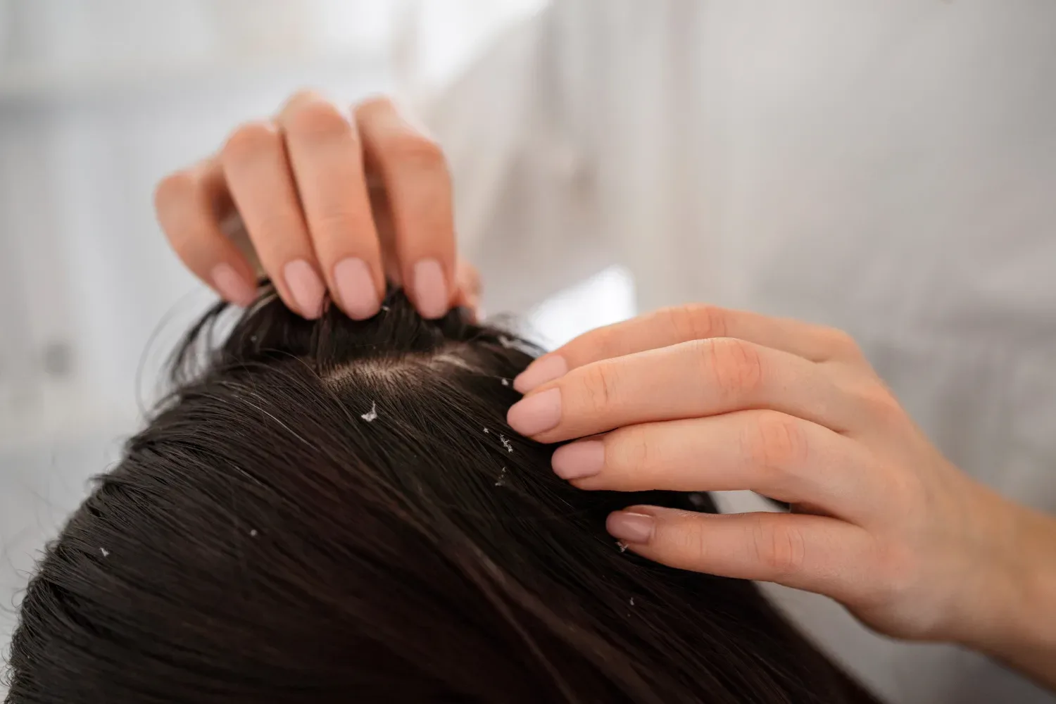 Kako se znebiti prhljaja za vedno: dermatologi razkrivajo ključno navado, ki odloča o zdravju vašega lasišča