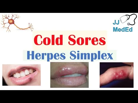 Se vam dela herpes? Če naredite TO, se sploh ne bo razvil (ustavite ga v 24 urah!)