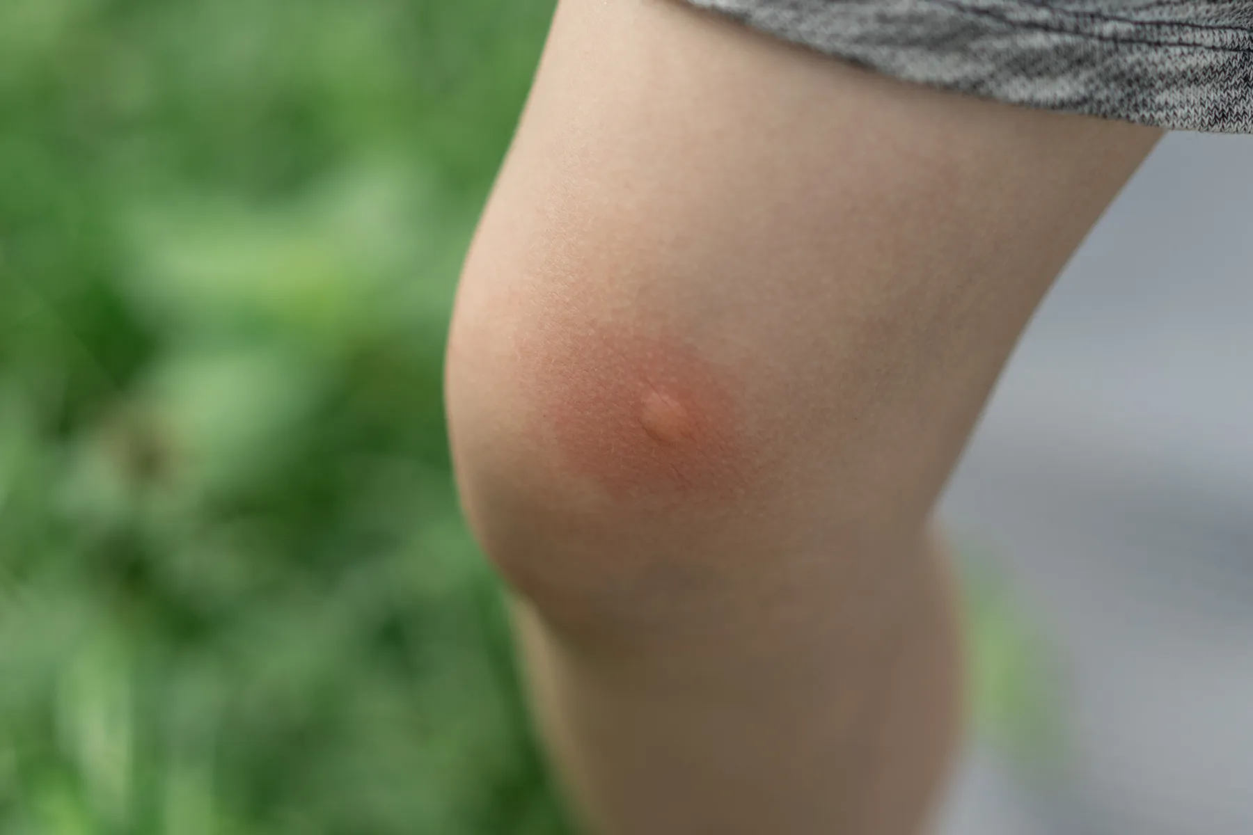 Trik z vročo žlico, ki pomiri ugriz komarja in ustavi srbenje v manj kot 30 sekundah