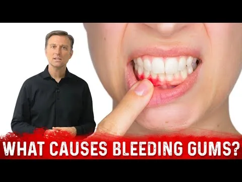 Vam med umivanjem zob krvavijo dlesni? Pozabite na mehkejše ščetke in drage paste, vaše telo nujno rabi TA vitamin