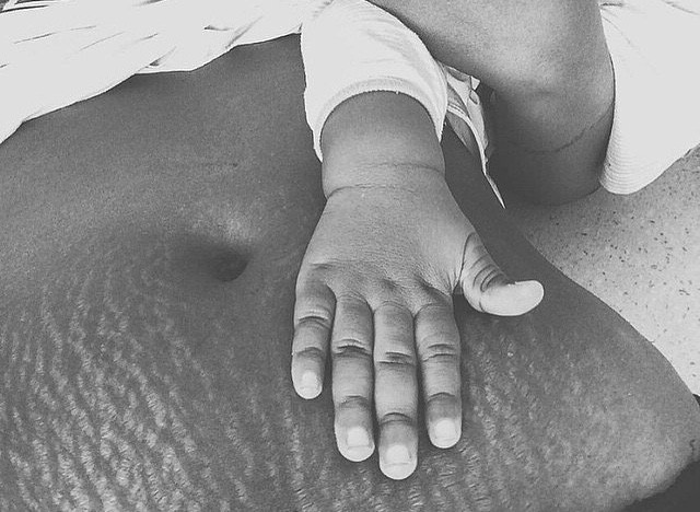 Love lines: Stretch marks go viral in support of women