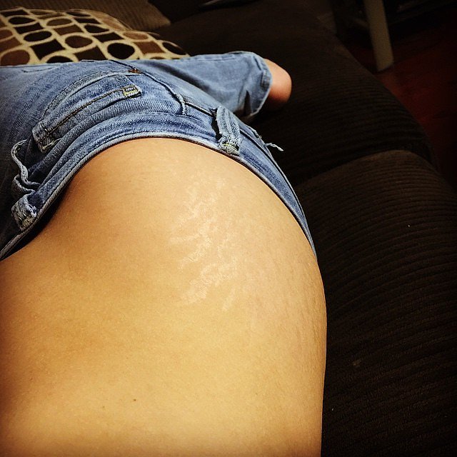 Love lines: Stretch marks go viral in support of women