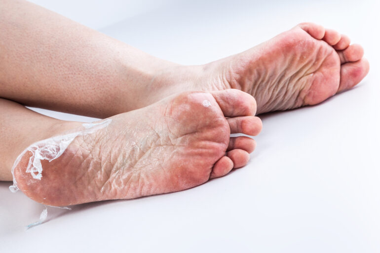 wirksame Behandlung von Fußpilz